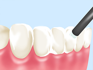 歯を強くするフッ素塗布