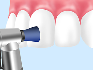 歯をクリーニング・PMTC（プロフェッショナル・メカニカル・トゥース・クリーニング）