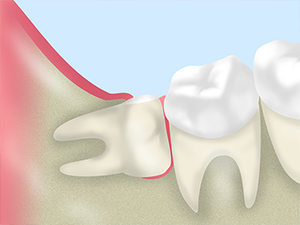 親知らずの抜歯