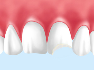 歯の外傷治療